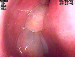 Poliposis nasal