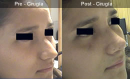 rinoplastia